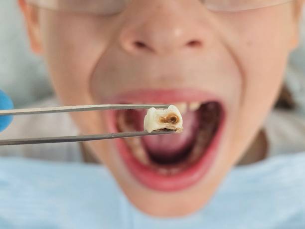 Best Emergency Root Canal Treatment in Nellieburg, MS